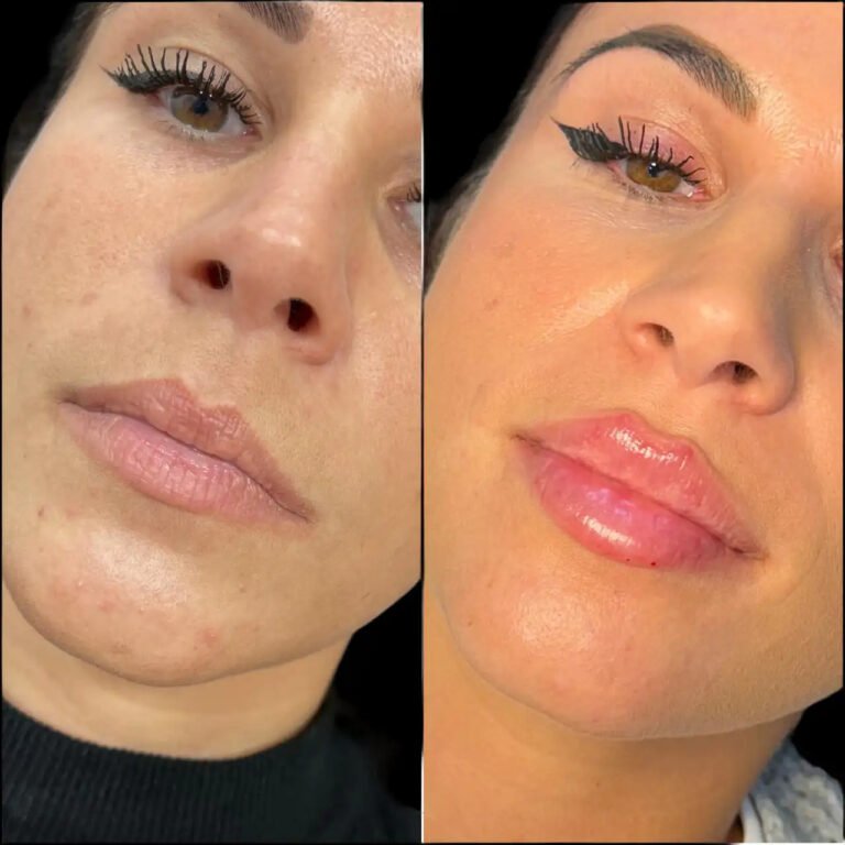 How Fillers Treatment in Dubai Can Refresh Your Appearance