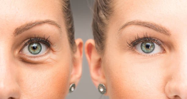 Eyelid Surgery in Islamabad: Achieve a Youthful, Refreshed Look