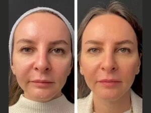 Mesotherapy Treatments in Dubai: Your Non-Surgical Skin Rejuvenation