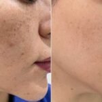 Pigmentation Solutions for All Skin Types in Dubai & Abu Dhabi | Glamorous Clinic Dubai