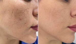 Pigmentation Solutions for All Skin Types in Dubai & Abu Dhabi | Glamorous Clinic Dubai