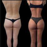 Why Patients Choose the Best Plastic Surgeon in Dubai for J-Plasma