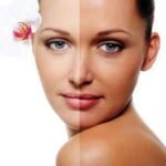 Chemical Peel Tan Removal in Dubai | Glamorous Clinic
