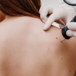 Breakout-Free Skin with Acne Treatment – Glamorous Clinic Dubai