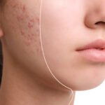 Acne Treatment in Vaishali Ghaziabad – Advanced & Personalised Care by Dr. Monica Bambroo