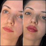 Best Aesthetic Clinic in dubai for Fillers: Affordable Aesthetic Solutions