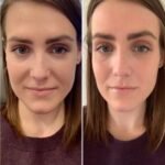 PRP Treatment in Dubai for Healthy Growth