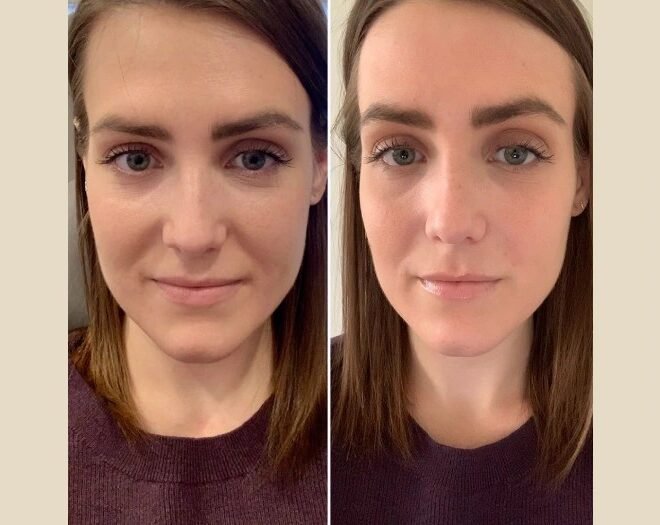 PRP Treatment in Dubai for Healthy Growth