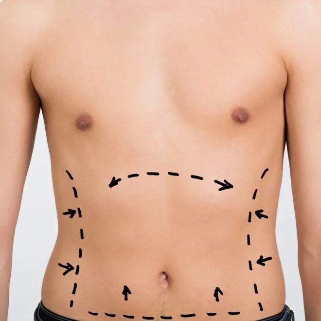 Tummy Tuck in Islamabad – Look Fit, Feel Confident