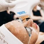 Get Youthful Radiance with BBL Laser in Manchester