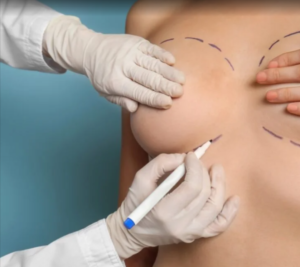MIA Breast Implant in Dubai – Advanced Medical Technology