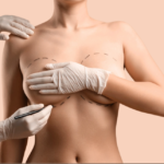 Breast Augmentation In Dubai