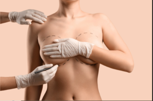 Breast Augmentation In Dubai