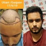 Hair Transplant Clinic in Gurgaon: How to Choose the Right Clinic