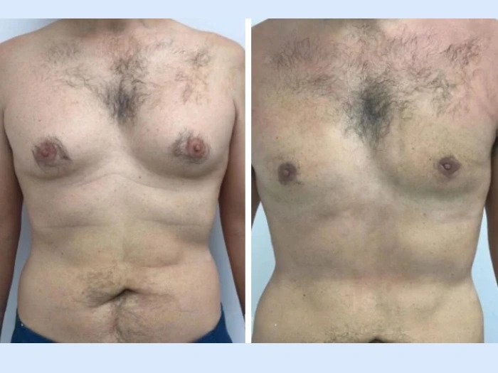 Best Doctors in Dubai for Gynecomastia and Improved Contours