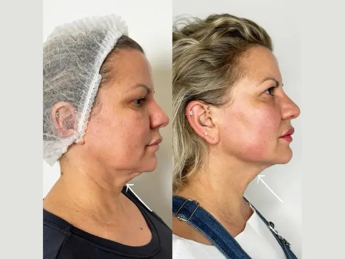 Best Plastic Surgeons in dubai for Innovative Endolift Aesthetic Care